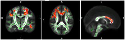 Thalamic-limbic circuit dysfunction and white matter topological alteration in Parkinson’s disease are correlated with gait disturbance